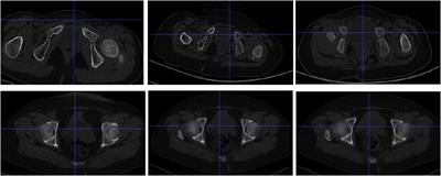 Intelligent diagnostic method for developmental hip dislocation